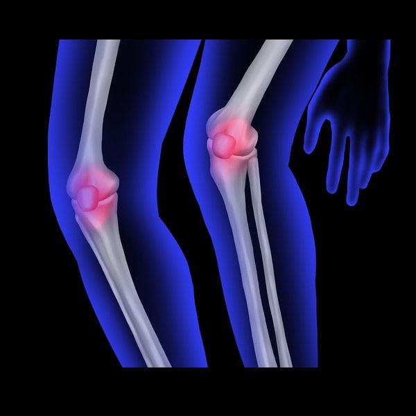 Artrosis de rodilla
